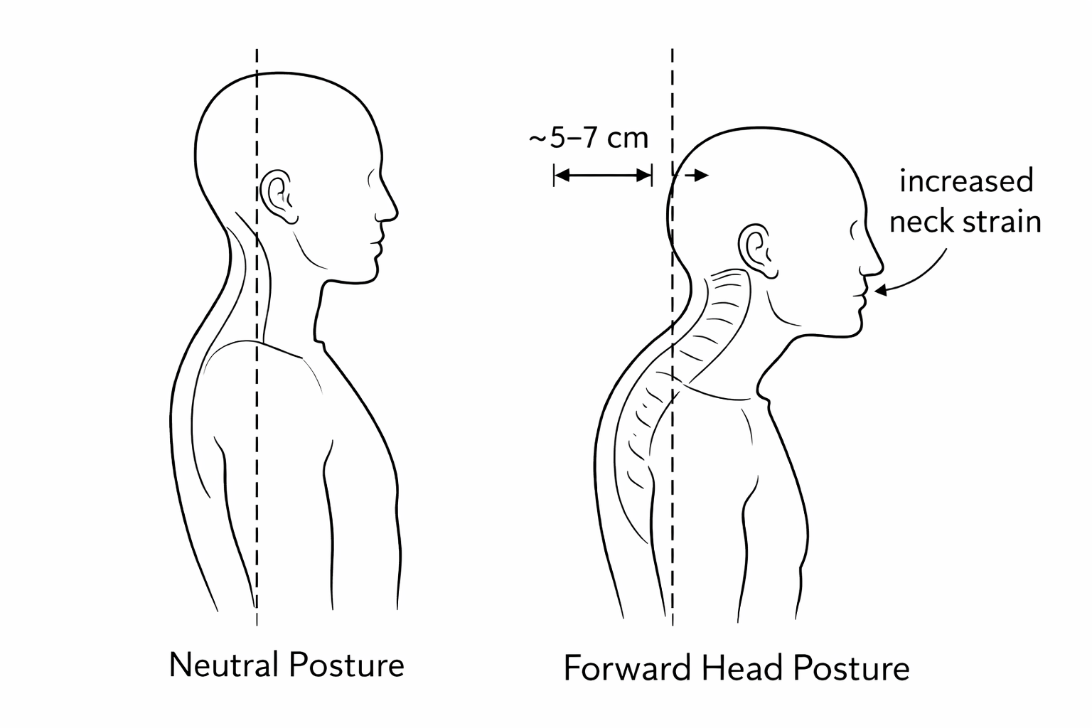 Forward head posture